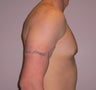 26 year old man has Gynecomastia Surgery