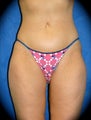 Thighplasty