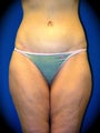 Thighplasty