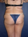Vaser Liposuction 