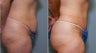 46 year old female with excess abdominal skin and laxity