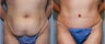 46 year old female with excess abdominal skin and laxity