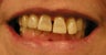 Restoration with Porcelain Veneers