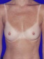 Breast Augmentation