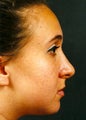 Rhinoplasty