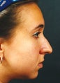 Rhinoplasty