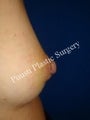 Nipple-Areola Repair