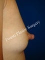 Nipple-Areola Repair