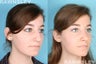 Rhinoplasty