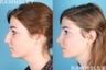 Rhinoplasty