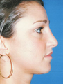 Rhinoplasty