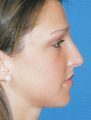 Rhinoplasty