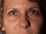 Eyelid Surgery