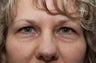 Eyelid Surgery
