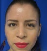 Rhinoplasty