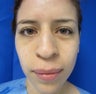 Rhinoplasty