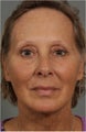 62 year old female with neck and jaw line laxity.  Also has facial volume loss around her eyes and cheeks.