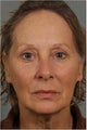 62 year old female with neck and jaw line laxity.  Also has facial volume loss around her eyes and cheeks.