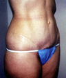 Tummy Tuck