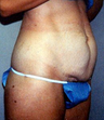 Tummy Tuck