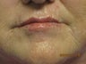 63 year old woman treated in perioral region with restylane 