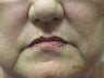 63 year old woman treated in perioral region with restylane 