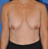 Breast Lift