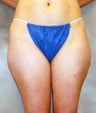 Thigh Liposuction
