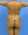 Butt Lift