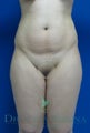 Liposculpture, Lipo Laser or Laser Lipolysis