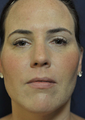 36 Year Old Female with Chin/Neck Lipo