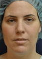 36 Year Old Female with Chin/Neck Lipo