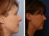 Rhinoplasty revision