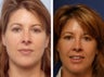 Rhinoplasty revision