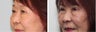 Before and 2 month after double eyelid surgery