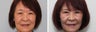 Before and 2 month after double eyelid surgery