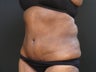 Tummy Tuck