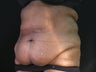 Tummy Tuck