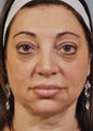 Sculptra to avoid surgery