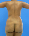 Brazilian Butt Lift - via fat transfer