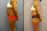 Tummy Tuck