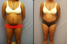 Tummy Tuck