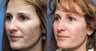 41 year old female treated for photoaging with Pixel Laser