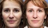 41 year old female treated for photoaging with Pixel Laser