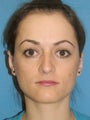 Otoplasty Ear Surgery - Female