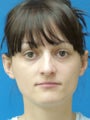 Otoplasty Ear Surgery - Female