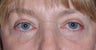58 Year Old Female Treated For Aging Eyes