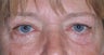 58 Year Old Female Treated For Aging Eyes