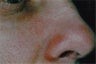 Facial vessels in adults