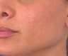 Mesotherapy